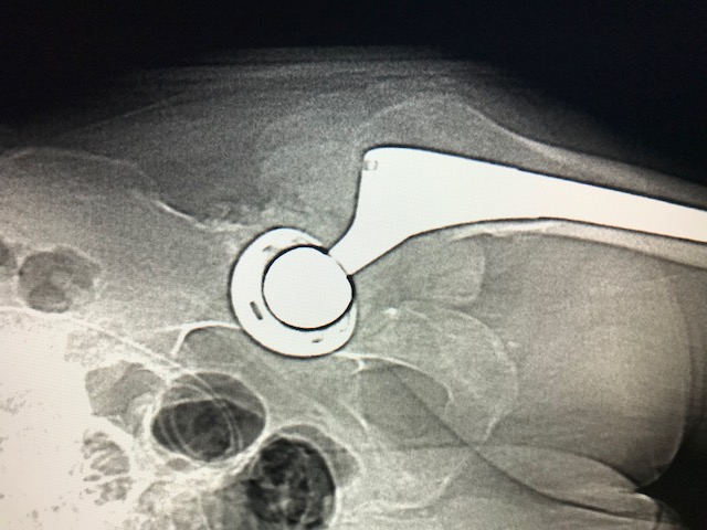 Figure 1 for case Tumoral calcinosis ( RID5202 )